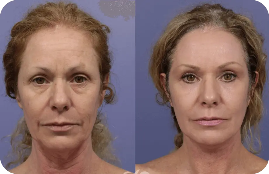 Synevra UltraLift review result no.3